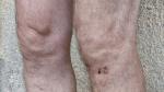 Foto: Z bolącym stawem w kolanie u fizjoterapeuty